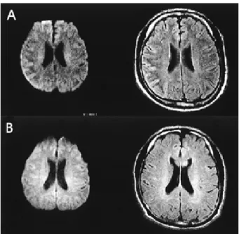 Figure 2. The initial brain  perfusion SPECT with Tc-99m  ECD. The figure reveals increased perfusion in the right  temporo-parietal cortex (A) which almost normalized on the  follow up SPECT after 2 months (B).