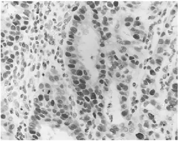 Figure  1.  Immunohistochemical  staining  for  Rb  evidences  high  expression  in  the  nuclei  of  tumor  cells  (×400)