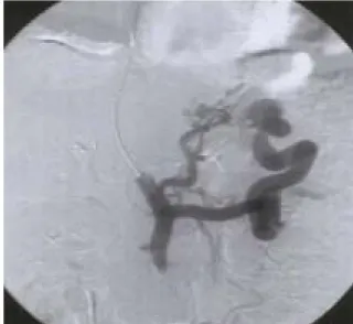 Figure 1. Computed tomography shows ill defined low attenuation mass in the right lobe of liver (arrow)