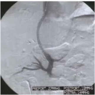 Figure 3. Portogram obtained after PTFE-covered Niti-S stent placement reveals disappearance of variceal flow.
