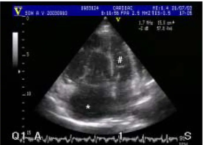 Fig. 1. Echocardiographic finding shows that dilated right  atrium and ventricle compress left ventricle (  Rt