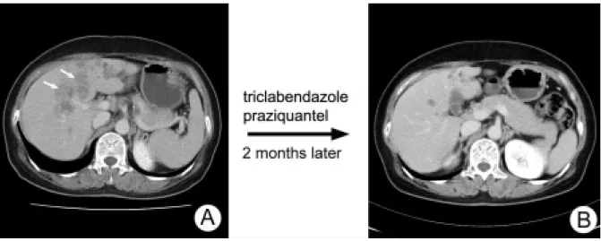 Figure 5. There are multiple, ill-defined, hypoattenuating lesions (arrow) in both hepatic lobes on the contrast-enhanced CT scan (A)