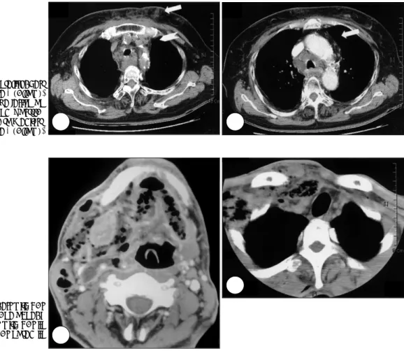 Fig. 3. A：Cellulitis on anterior chest  wall were noted in case 2 (arrow). 