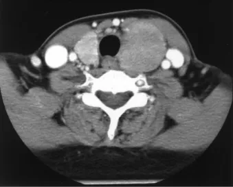 Fig. 2. Cut surface of the specimen revealed pale tan nodular lesion involving nearly entire thyroid gland