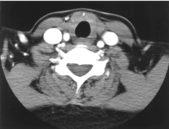 Fig. 5. Postoperative neck CT reveals non visualization of thyroid gland and no demonstrable recurred mass or metastatic lymph node