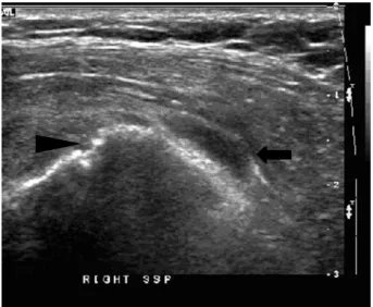 Fig.  3.  The  distended  subacromial-subdeltoid  bursa  (arrow)  filled  with  fluid  indicating  bursitis  and  the  cortical  irregularity  of  the  greater  tubercle  (arrow  head)  were  seen  in  long  axis  view