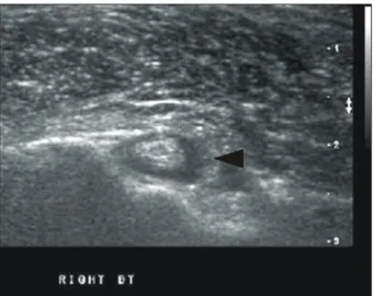 Fig.  5.  The  hypertrophy  and  superior  distension  of  the  acromio-  clavicular  joint  capsule  indicating  osteoarthritis  were  seen  in  long  axis  view.