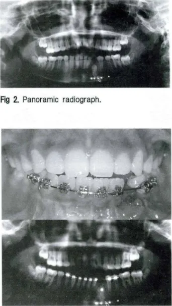 Fig  3.  A  tria l  of  closed  eruption.