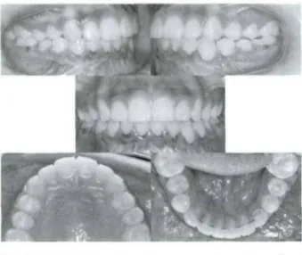 Fig  5.  Rem oval  of  m iniplate.