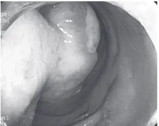 Fig. 2.  Abdominal computed tomography. About a  4cm sized polypoid mass is located in the  mid-transverse colon