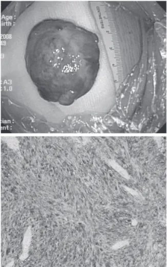 Fig. 4.  Pathology. A, Grossly, the resected tumor is  a globular and solid submucosal tumor