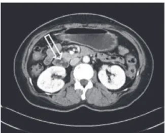 Fig. 1.  Abdominal CT scan finding. It shows a  polypoid mass in duodenal lumen extending  to the third duodenal portion (arrow).