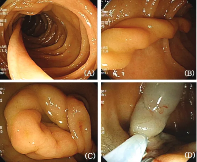 Fig. 2.  Endoscopic findings. (A) It shows a pedunculated polyp with long stalk on the second duodenal portion