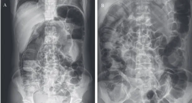 Fig. 1.    Initial simple abdomen X-ray. Erect (A) and supine (B) view, when she complained abdominal pain