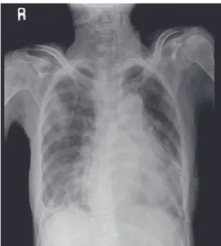 Fig. 1.  Initial chest X-ray shows multifocal patchy  consolidations in both lung fields.