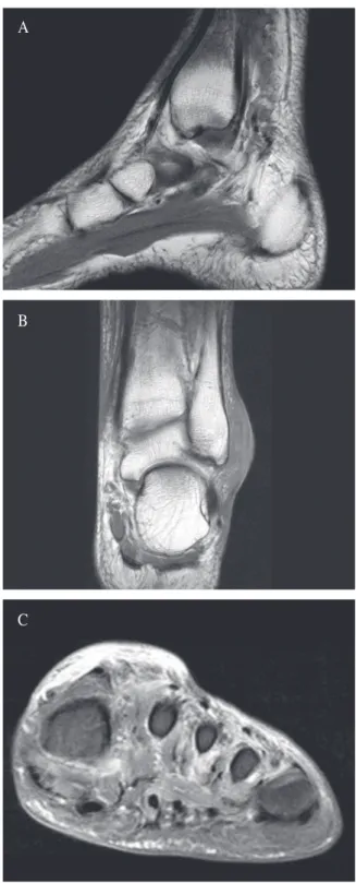 Fig. 1.  MRI finding of left ankle and foot. A)  Subcutaneous fat tissue swelling and edema  of lower leg and foot, B) Ulcerative lesion  with abscess formation over lateral  malleolus, C) Pus collection in lateral aspect  of dorsum of foot.