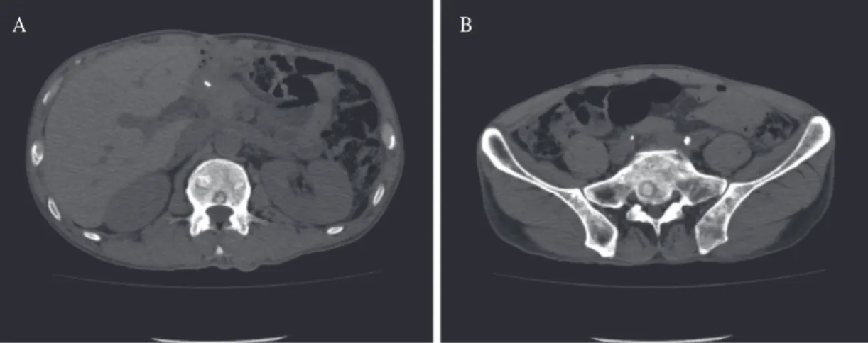 Fig. 2.  Chest CT scan showed bone metastasis in  spine.