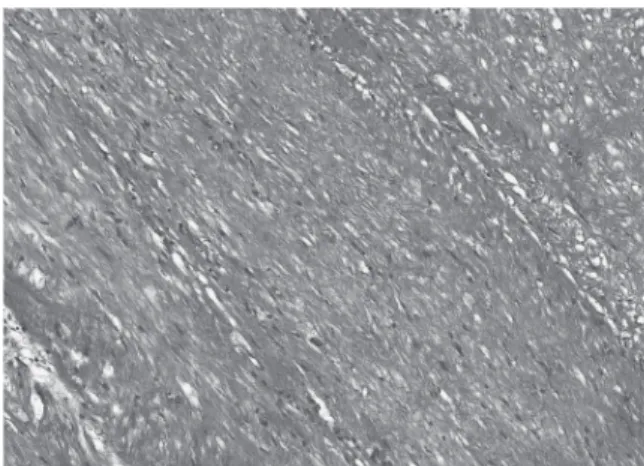 Fig. 5.   Microscopic findings of mass show bundles  of eosinophilic spindle cells.