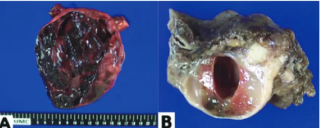 Fig. 3.   A: Numerous benign thyroid follicles within the left ovarian stroma are seen (H&amp;E, ×100)