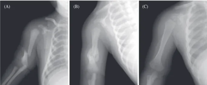 Table 3.  Obstetric long bone fractures in previous and our reports