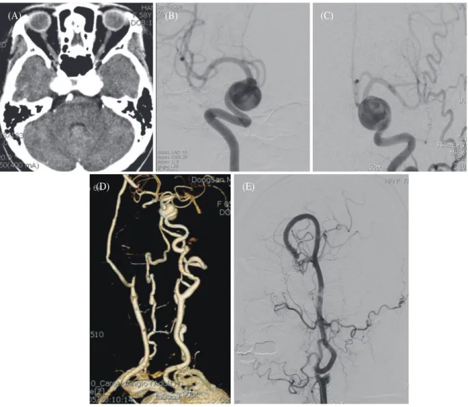 Fig. 1.    (A) Enhanced brain CT, axial view, showing large aneurysms at the bilateral cavernous portion of  the ICAs