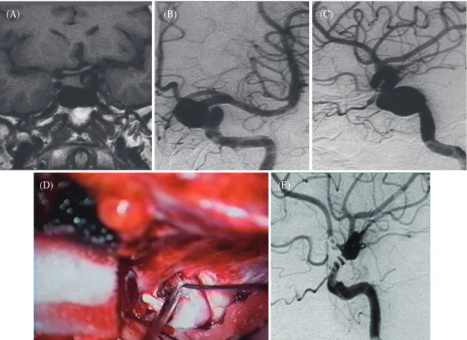 Fig. 2.    (A) Brain sella MRI, coronal view, showing a large aneurysm of clinoid segment of left ICA which  elevates the left side of optic chiasm