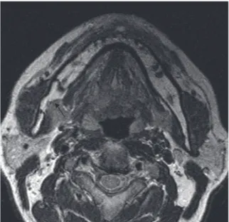 Fig. 4.   Panoramic CT view shows oval-shaped radiolucent defect with sclerotic margin at left body of  mandible, suggestive of Stafne's bone defect.