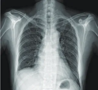 Fig. 2.  Chest CT scan shows multiple tiny nodules    with random distribution in both lungs.