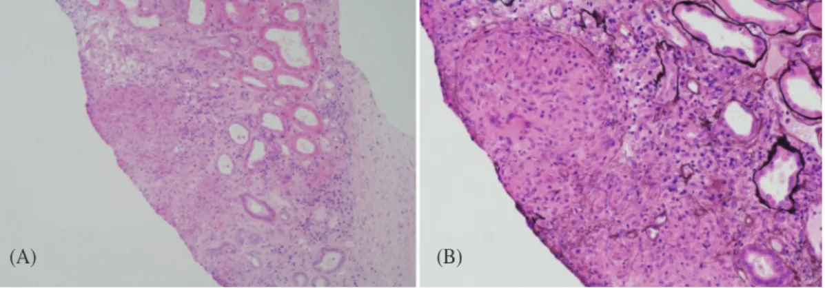 Fig. 3.   Allograft kidney biopsy specimen shows caseous necrosis and giant cells along with lymphocytes (H&amp;E   stain A ×100, B ×200).