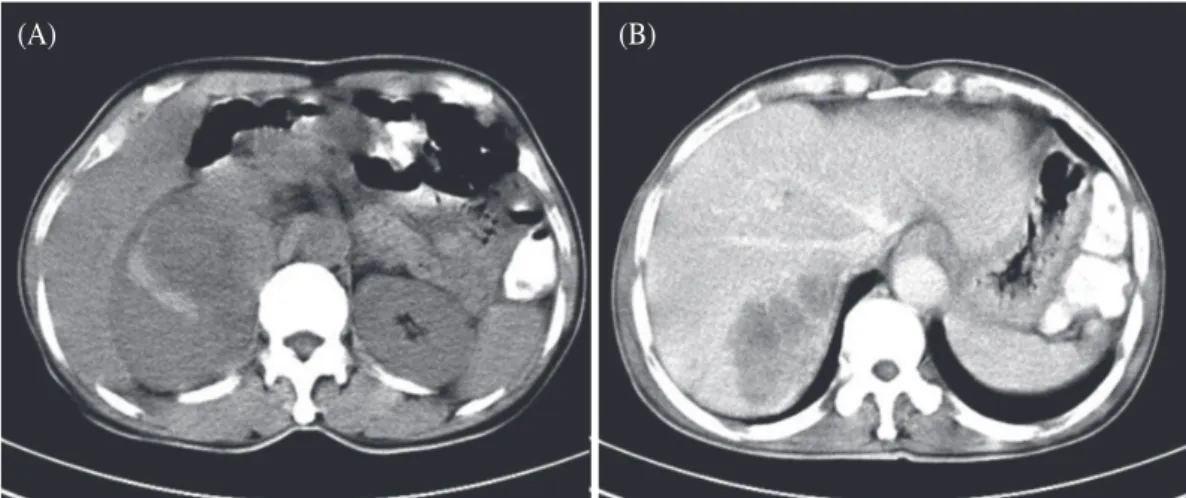 Fig. 1.   (A) Cotrast enhanced CT shows ill-defined inhomogeneous lesion in the right adrenal gland