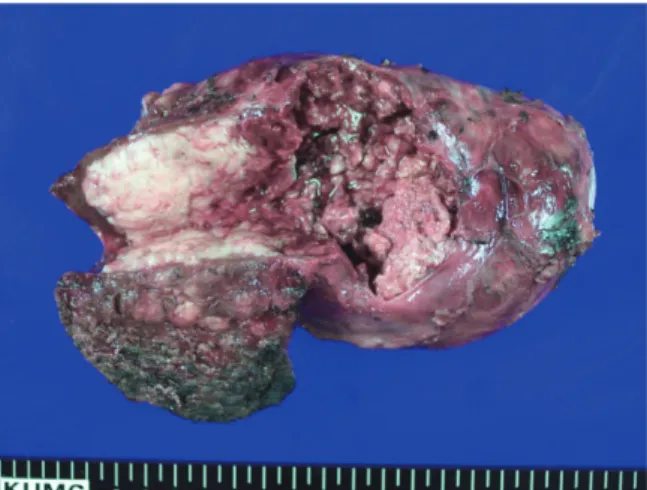 Fig. 2.  Bisected gross finding of intrahepatic and  protruding tumor mass, measuring 17.0 cm in  maximum length.