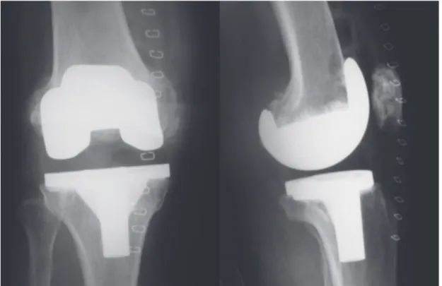 Fig. 3.    Anteroposterior and lateral plain radiographs of the right knee after polyethylene change surgery shows well   positioned polyethylene insert.