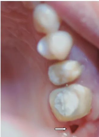 Fig. 1.  Small defect posterior to maxillary first    molar.