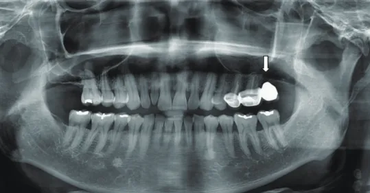 Fig. 3.  CT scan showed a bony defect of left maxillary 