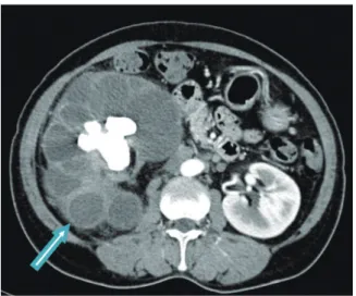 Fig. 2.  Abdominal CT  The arrow indicates a  markedly hydronephrotic right kidney with  caliceal stones