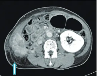 Fig. 3.  Gross specimen  Right kidney shows severe  hydronephrosis with multiple brown sandy  stones
