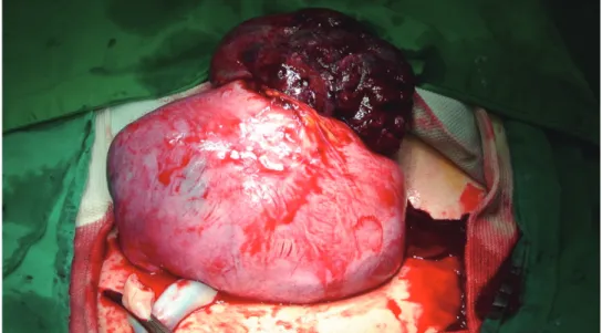 Fig. 3.   Uterine rupture.  Placenta is seen protruding through the ruptured site. 불완전파열로  분류되는데  완전  파열은  자궁  전층이  파열되어  태아나  태반이  산모의  복강내로  돌출되는  경우이고  불완전파열은  자궁의  장막층  또는  내장  복막이  건재하여  태아나  태반이  복강내로  탈출하지  않은 경우이다[4]