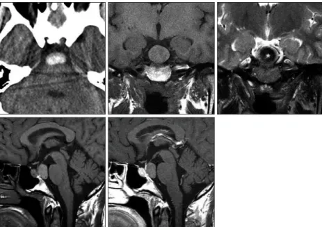 Fig. 2. Operative and pathology features of a Rathke’s cleft cyst in the pre- pre-pontine cistern