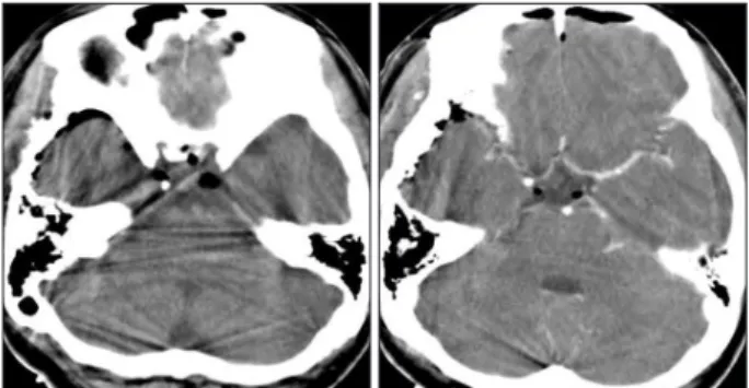 Fig. 3. Postoperative computed tomography scans exhibit disappear- disappear-ance of the hyperdense cyst behind the pituitary fossa
