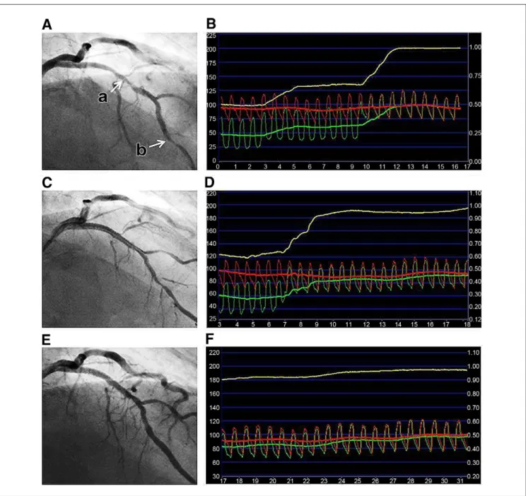 Figure 1. Representative Case of FFR with Pullback Pressure Tracing-Guided PCI