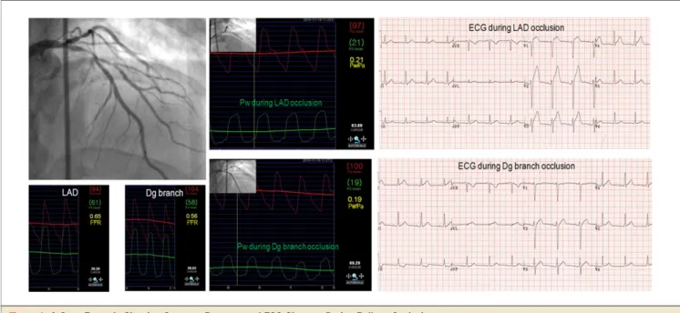 Figure 1. A Case Example Showing Coronary Pressure and ECG Changes During Balloon Occlusion