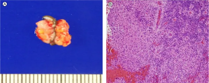 Figure 2. (A) Gross specimen of the right breast shows an irregular-shaped mass with a size of 1 × 0.8 × 0.7 cm