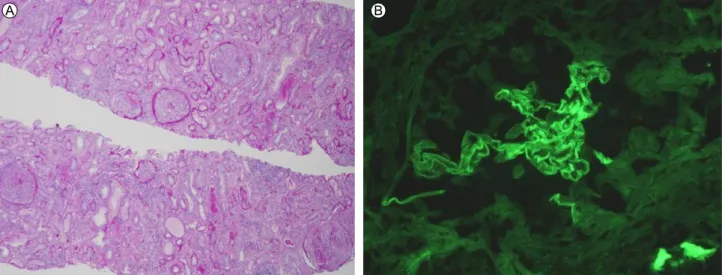 Figure 1. (A) There are crescent formations. The glomerulus does not show mesangial proliferation or basement membrane thickening