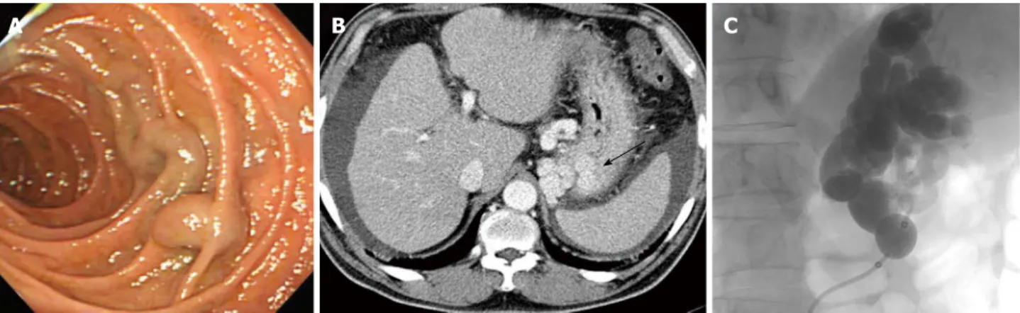 Figure 1  Endoscopic variceal ligation was performed to control variceal bleeding. A: Tiny nodular varices with no bleeding were found at the duodenum second  portion; B: Enhanced computed tomography scan showing large gastric varices (arrow); C: Balloon o