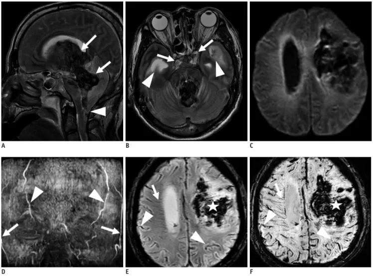 Table 3 summarizes the statistical analysis of each MRI  finding of brain death.