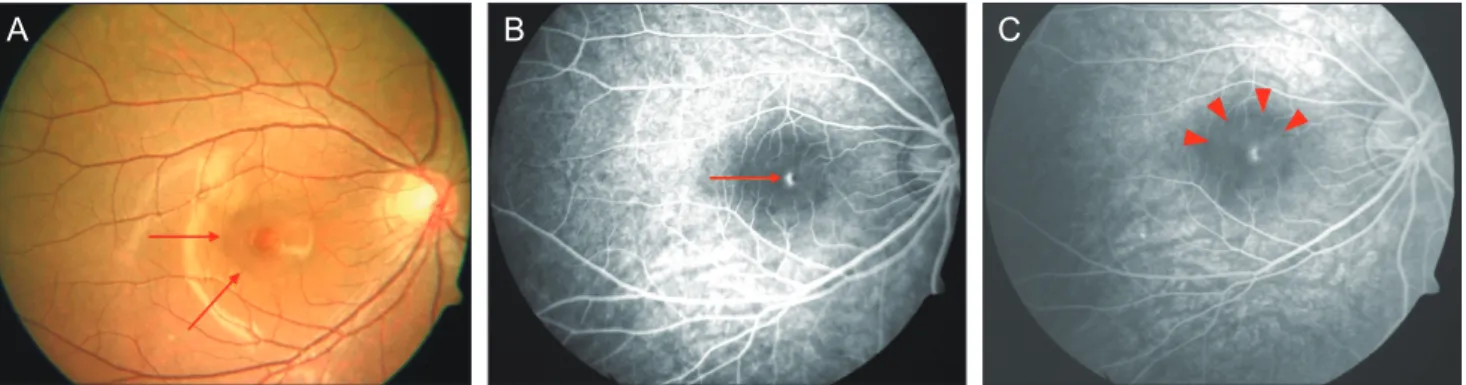 Fig. 2. (A) Optical coherence tomography (OCT) at the time of the first visit shows serous neurosensory retinal detachment (asterisk)