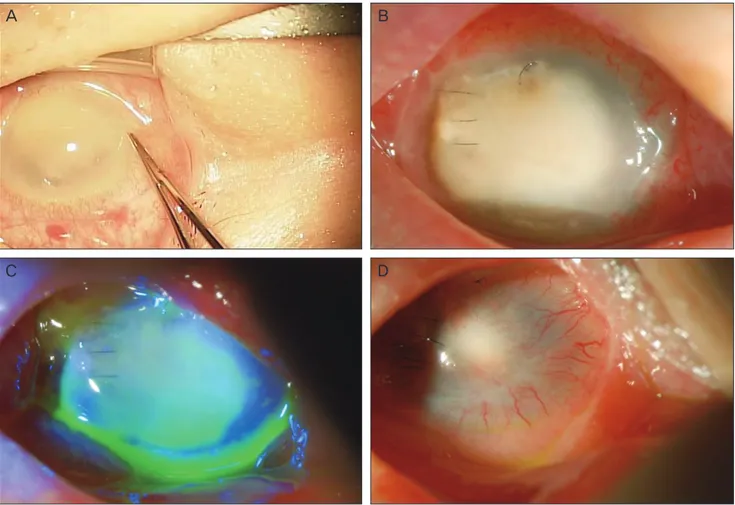 Fig. 1. External ocular surface photography. (A) In the operating room, severe corneal stromal melting and infiltration was observed be- be-fore surgery