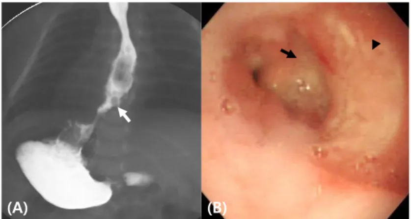Fig. 1. A barium meal study showing an ulcer-like lesion (arrow) in the distal  esophagus (A)