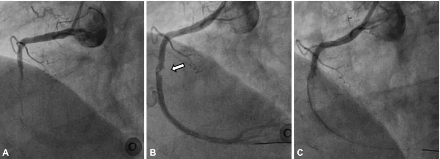 Fig. 1. Coronary angiogram demonstrated acute stent thrombosis during primary percutaneous coronary intervention
