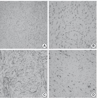 Fig. 1. A soft tissue perineurioma arising in the skin. Micrographs  (A, B) show proliferation of spindle cells with wavy nuclei and  deli-cate elongated bipolar cytoplasmic processes